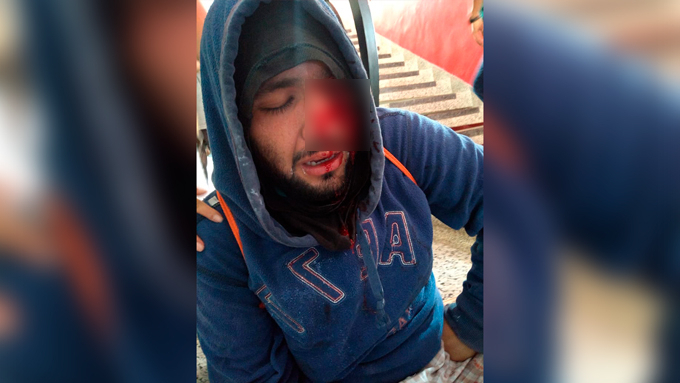 Estudiante perdió un ojo al recibir el impacto de una bomba aturdidora en  medio de protestas en Popayán | Minuto30.com